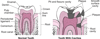 Types de caries