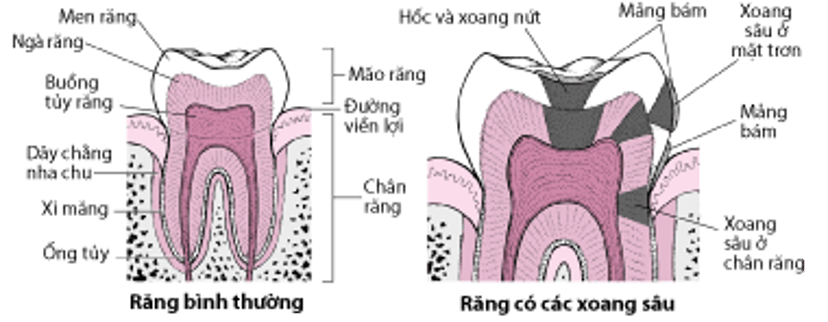 Các loại sâu răng