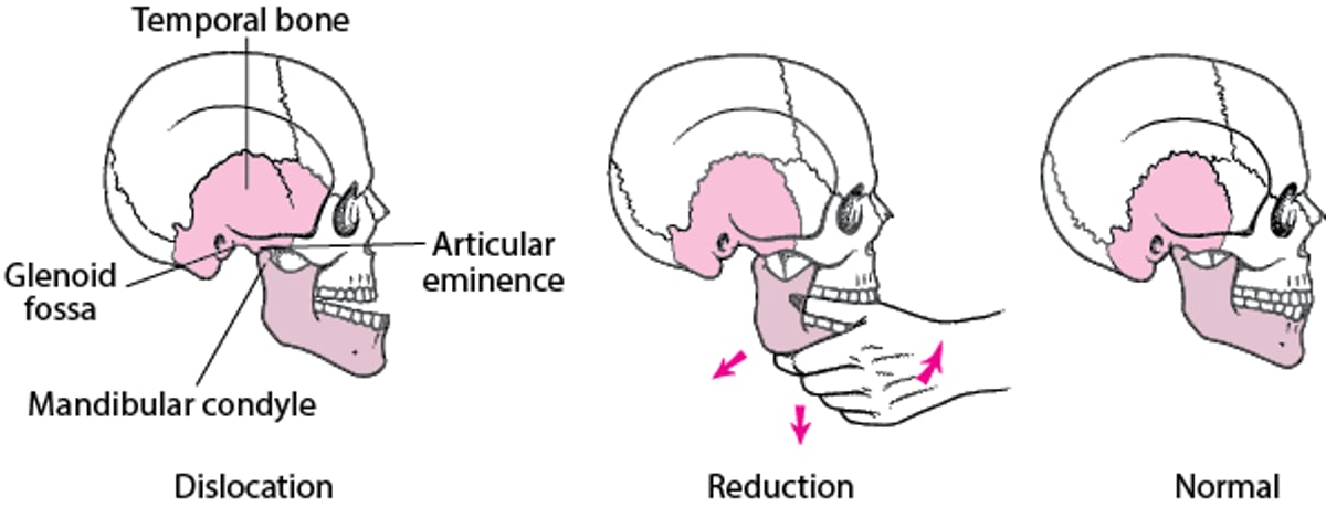Mandibular Reduction