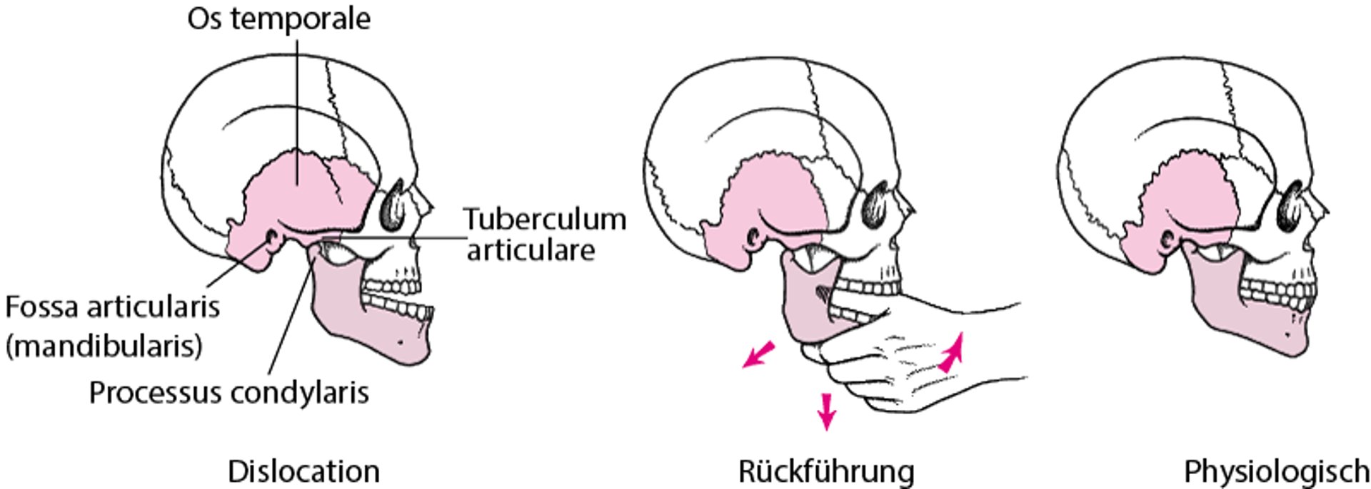 Unterkieferreposition