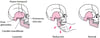 Reducción mandibular