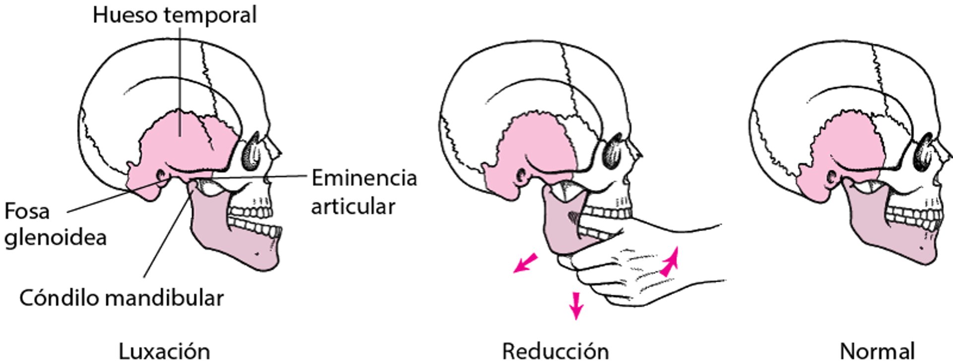 Reducción mandibular