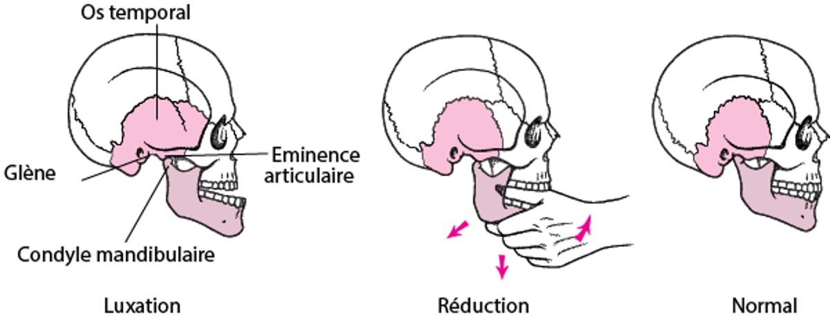 Réduction mandibulaire