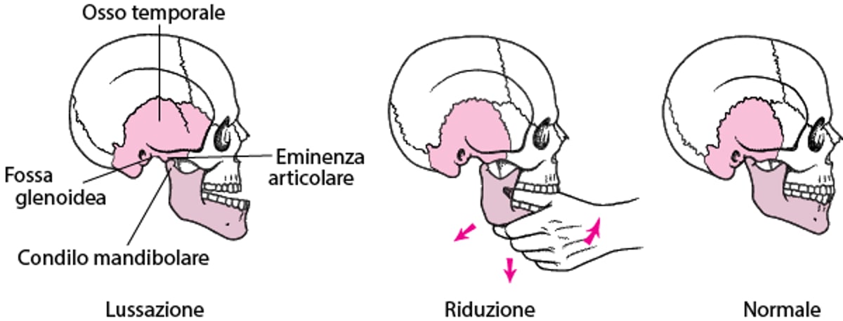 Riduzione mandibolare