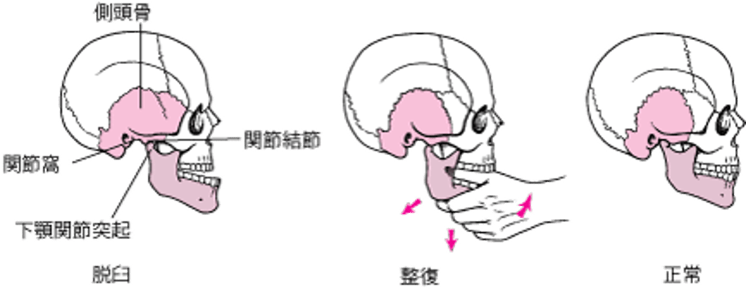 顎関節脱臼整復術