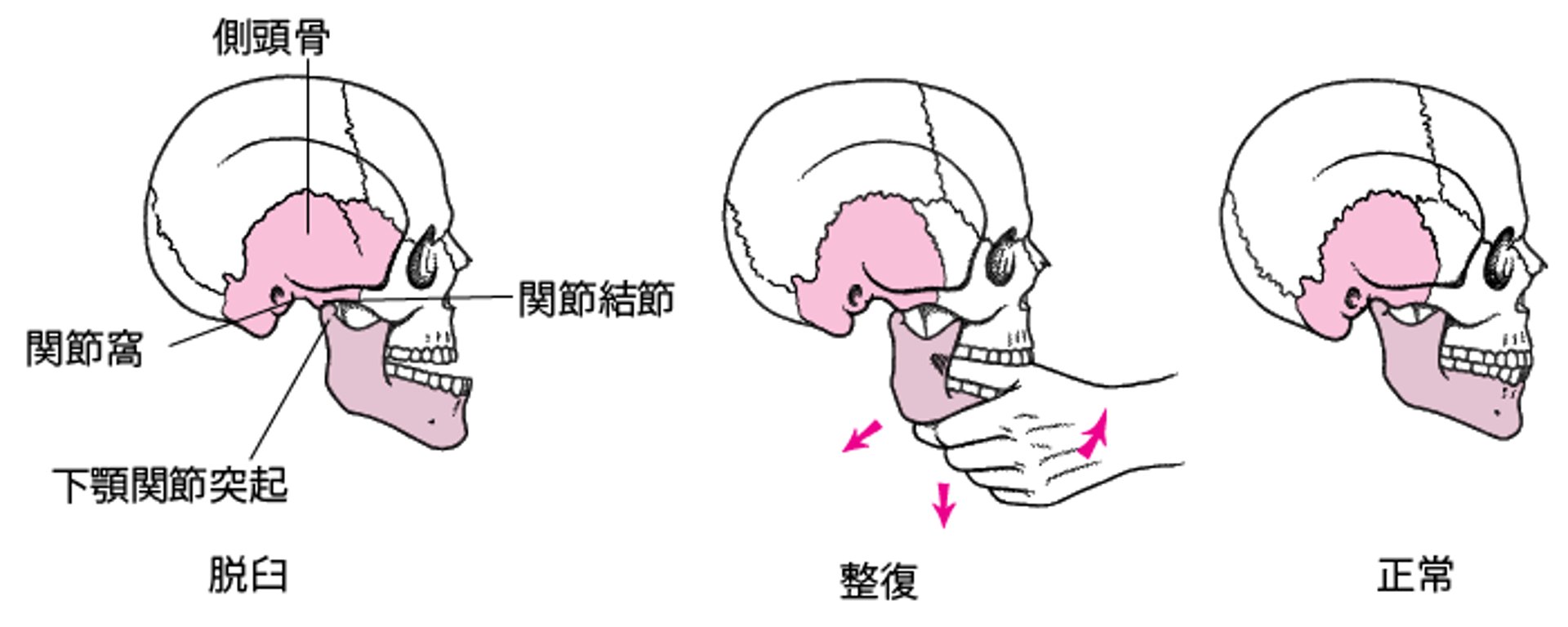 顎関節脱臼整復術