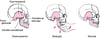 Redução mandibular