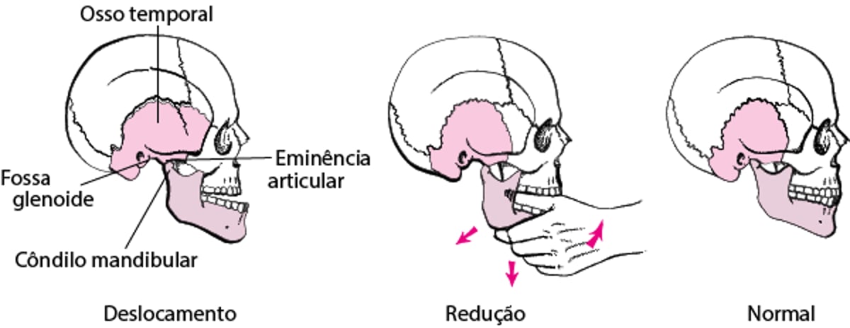 Redução mandibular