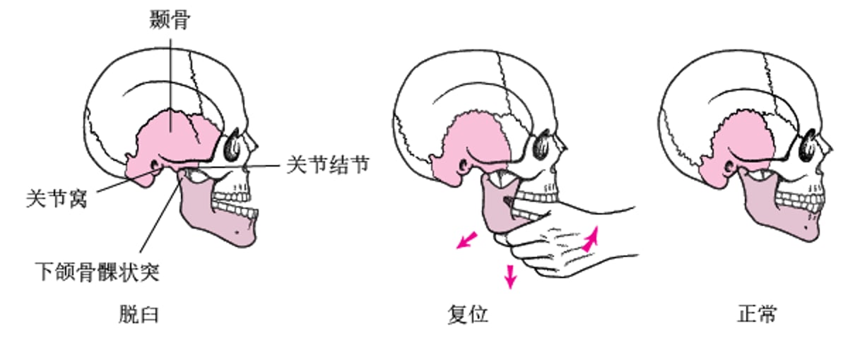 下颌骨复位
