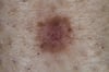 Dermatofibroma