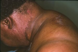 Dermatomiositis (Cuello)