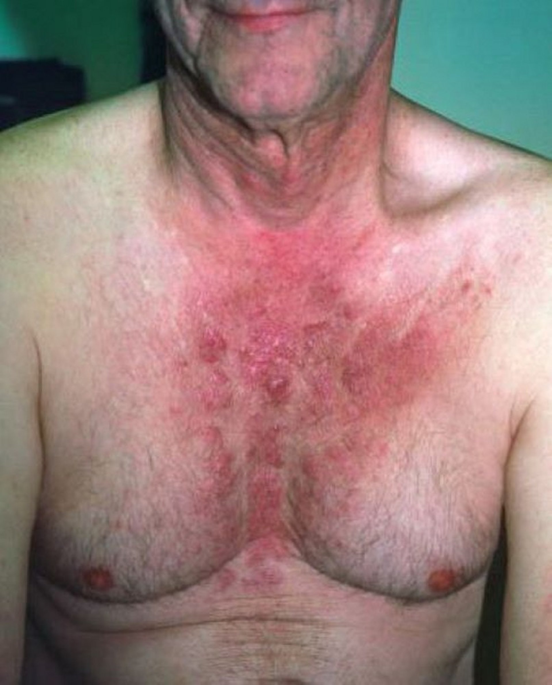 Dermatomyositis (Resulting From Colon Cancer)