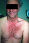 Dermatomiositis (resultante de cáncer de colon)