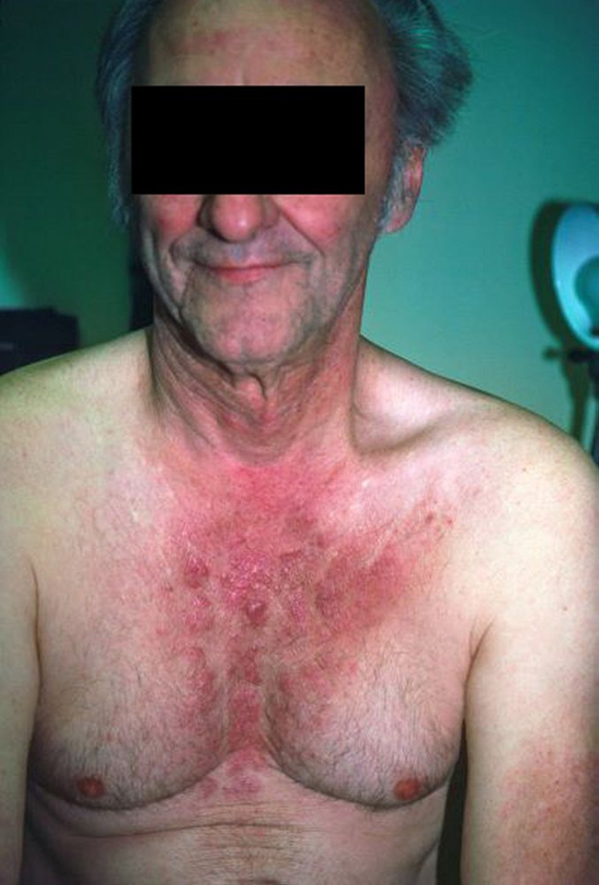 Dermatomyosite (résultant d'un cancer du côlon)