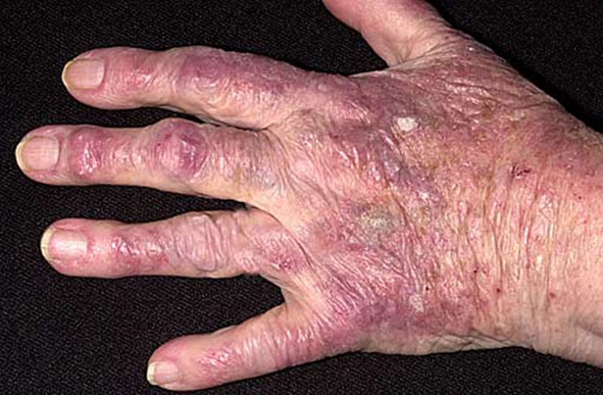 Dermatomyositis
