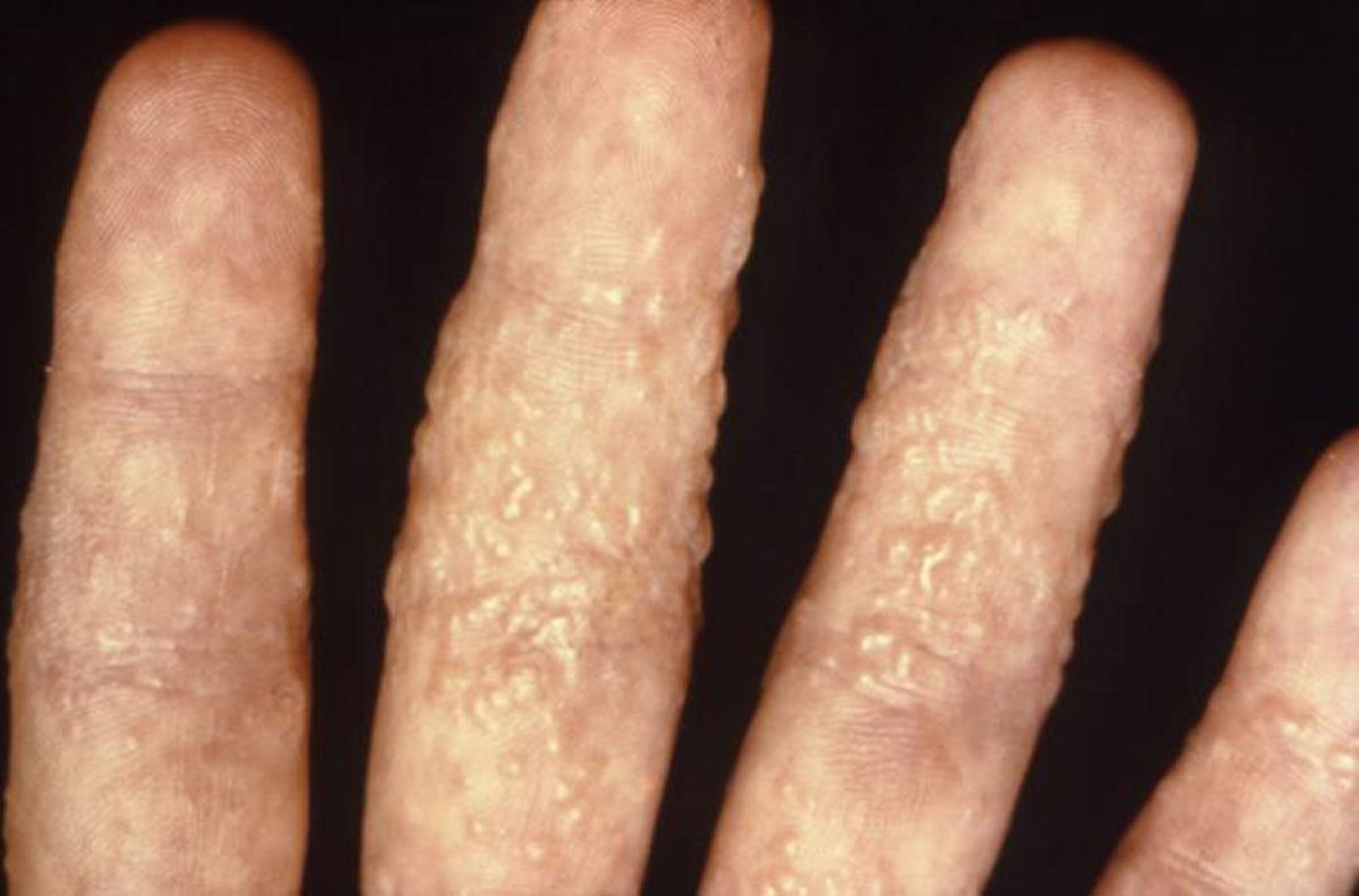 Dermatophytid Reaction