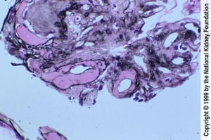 Néphropathie diabétique (hyalinose)