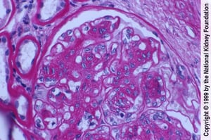 Néphropathie diabétique (prolifération des cellules mésangiales et expansion de la matrice)