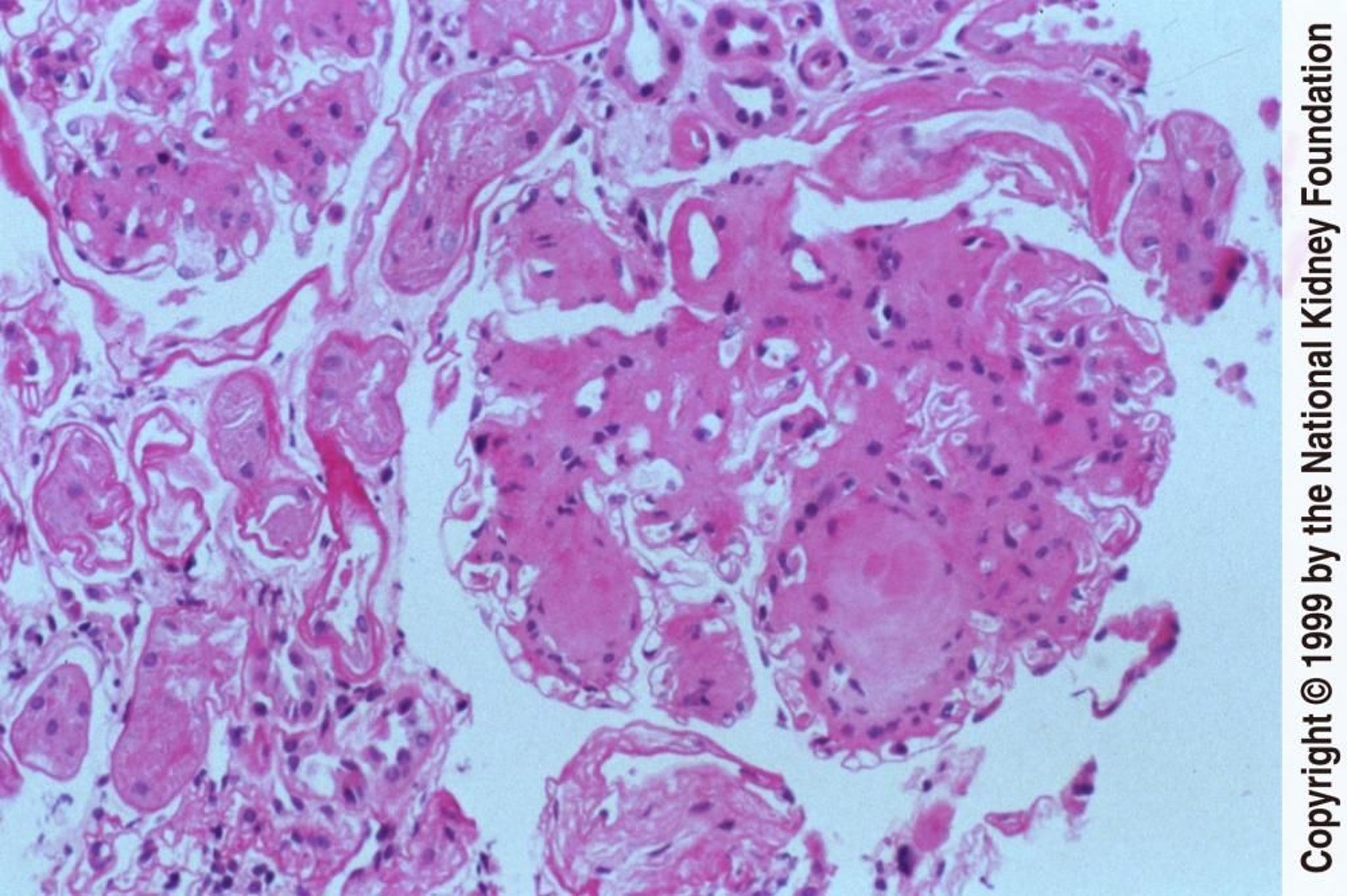 Nefropatía diabética (nódulos)