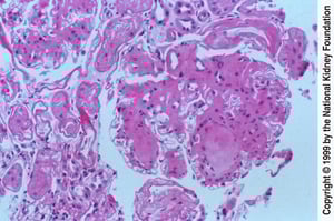 Néphropathie diabétique (nodules)
