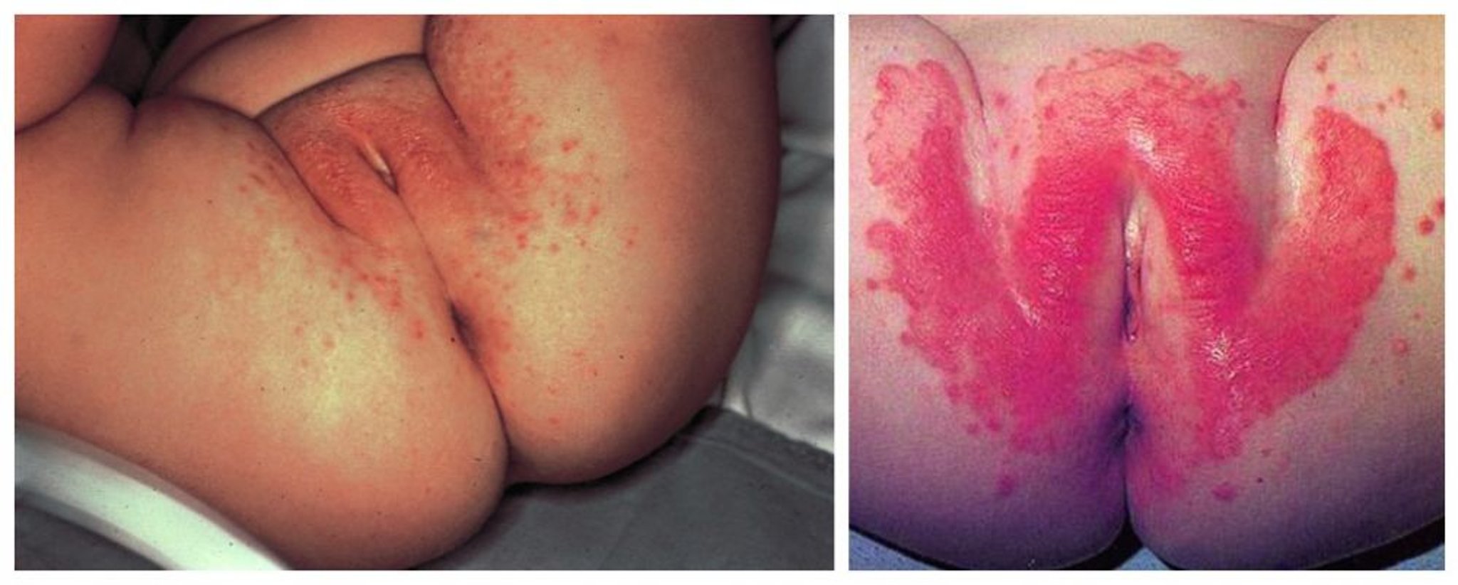 Windeldermatitis mit Papulopusteln
