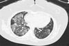 Diffuse Alveolar Hemorrhage