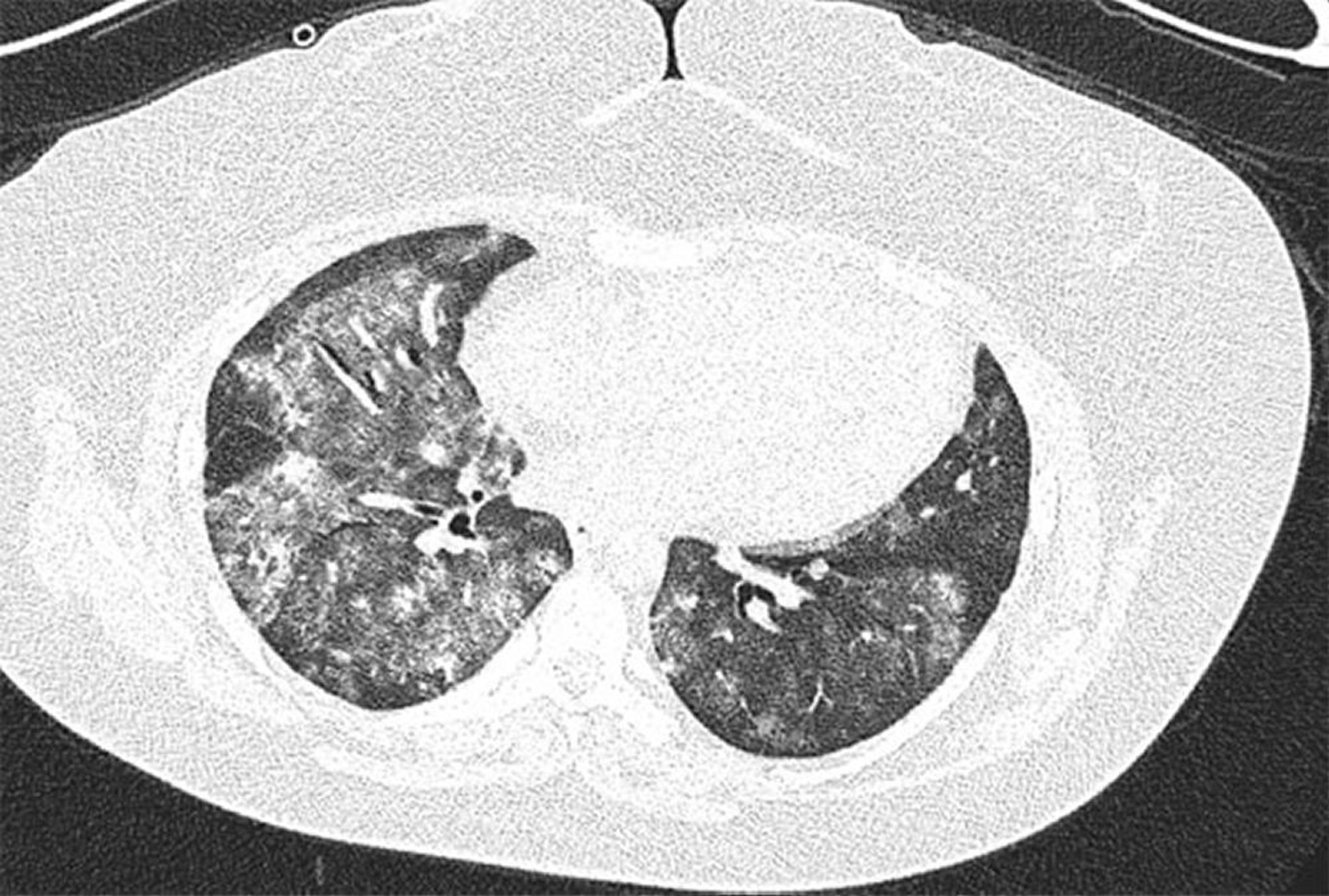 Hémorragie alvéolaire diffuse