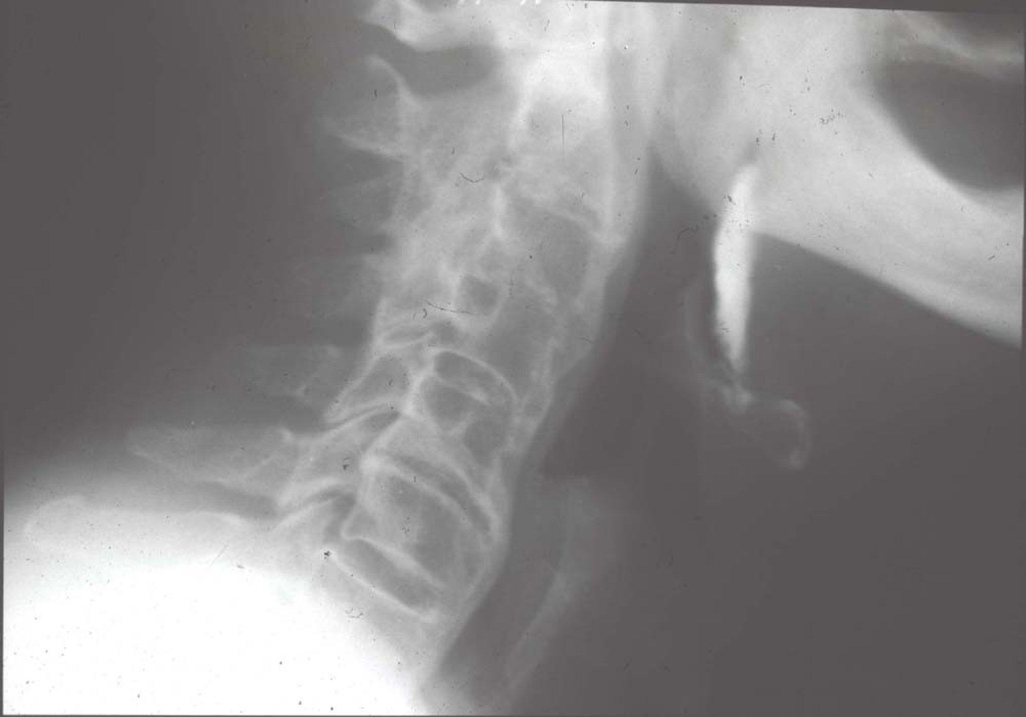 Diffuse Idiopathic Skeletal Hyperostosis (Radiograph)