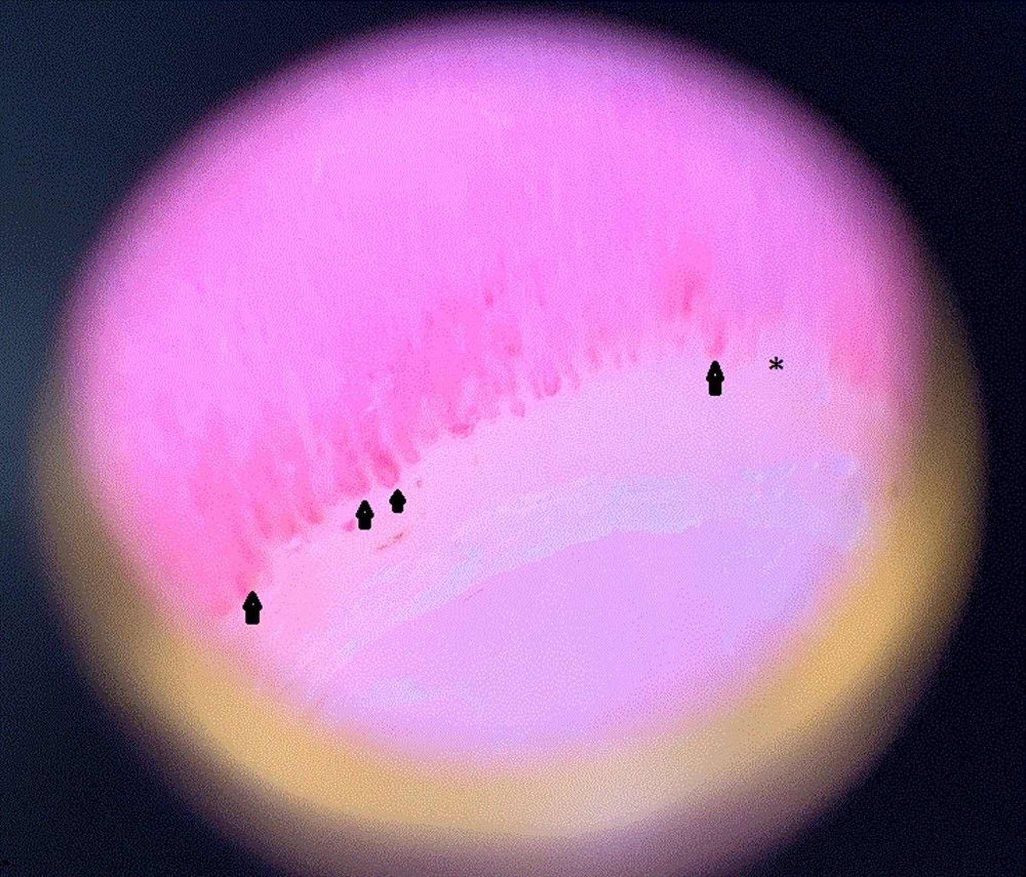 Dilated Capillary Loops