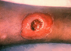 Difteria cutánea (ulceración central)