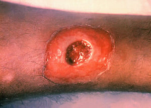皮膚ジフテリア（中心部潰瘍）