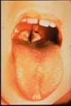 Diphtheria (Nasopharyngeal Membrane)