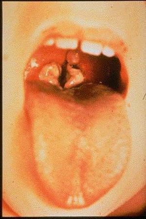 ジフテリア（偽膜を生じた上咽頭感染）