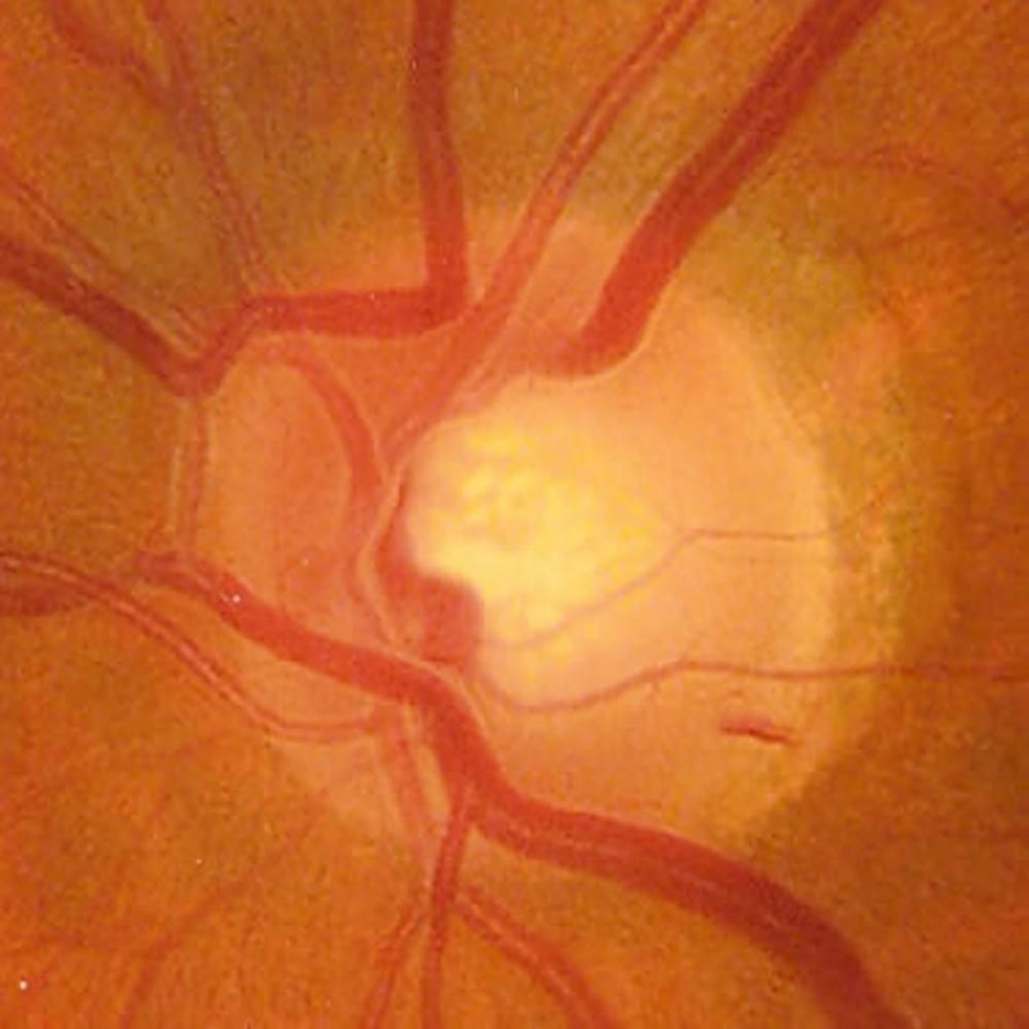Glaucoma (hemorragia en la papila óptica)