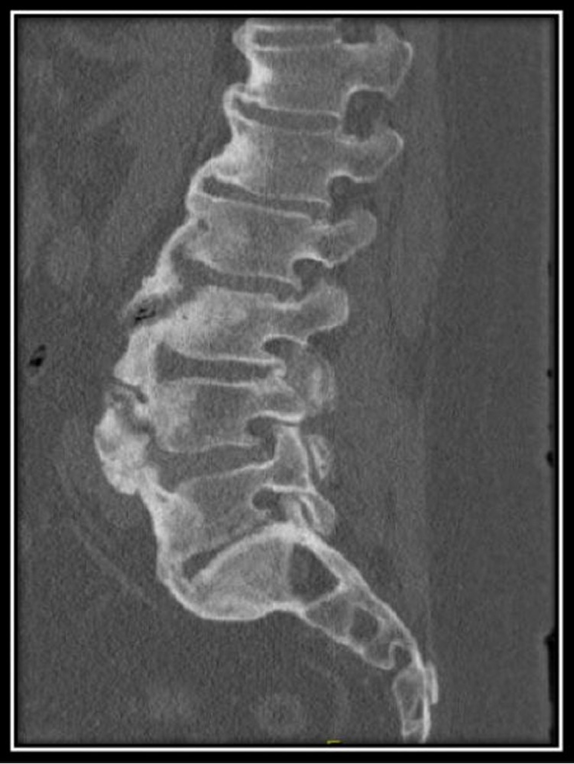 Diffuse Idiopathic Skeletal Hyperostosis (CT Scan)