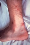 Infection gonococcique disséminée (lésions cutanées)