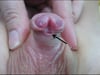 Hypospadias distal