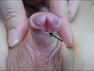 Hypospadias distal