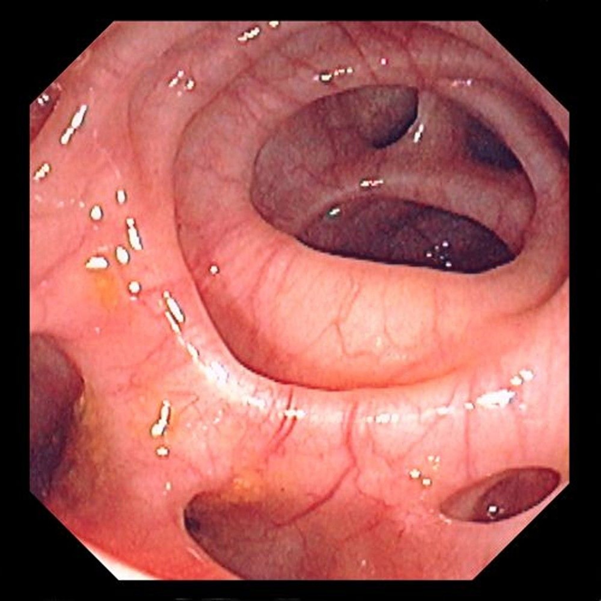 Diverticulosis