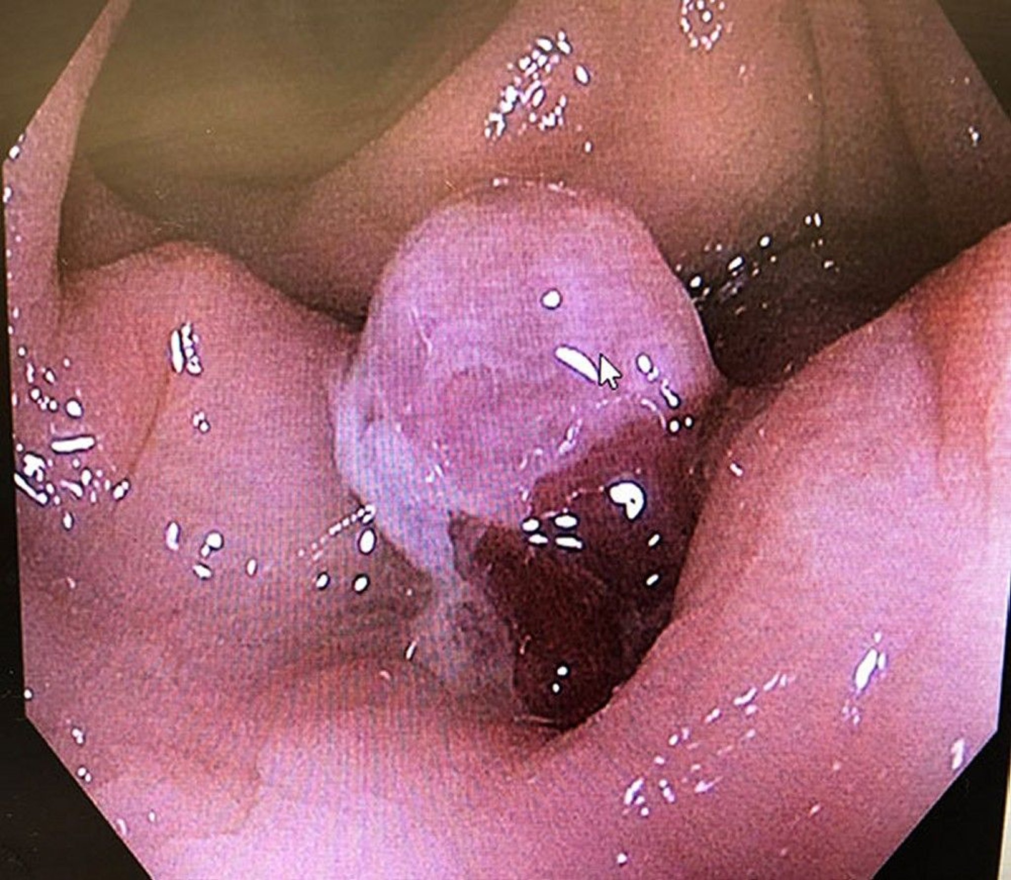 Diverticulitis (Granulation Tissue)