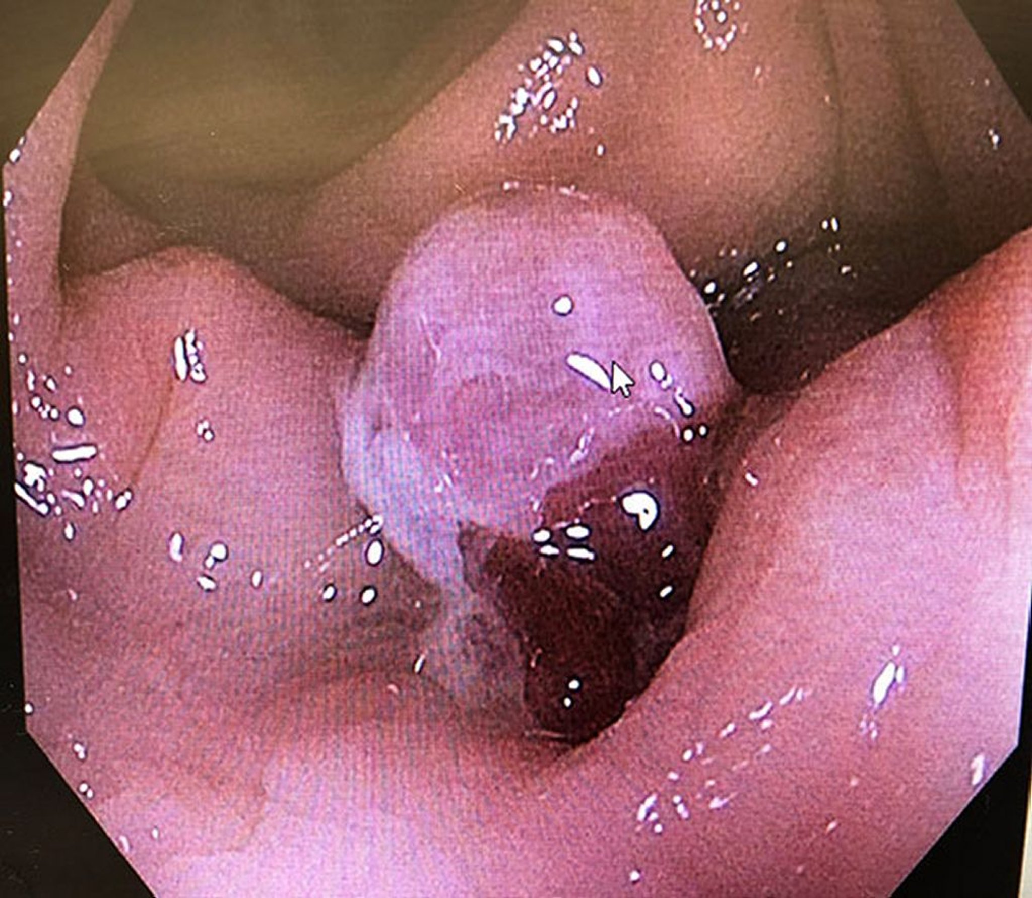 Diverticulitis (tejido de granulación)