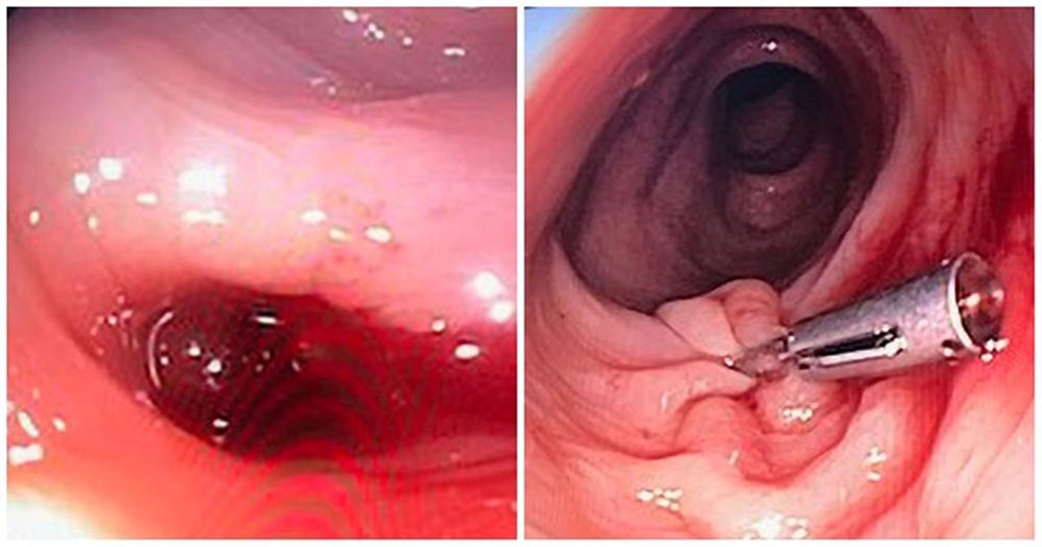 Diverticulum With Bleeding