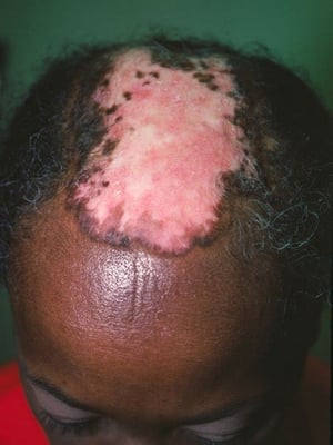 Discoid Lupus Erythematosus (Scalp)