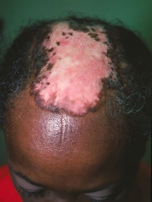 Lupus eritematoso discoide (cuero cabelludo)