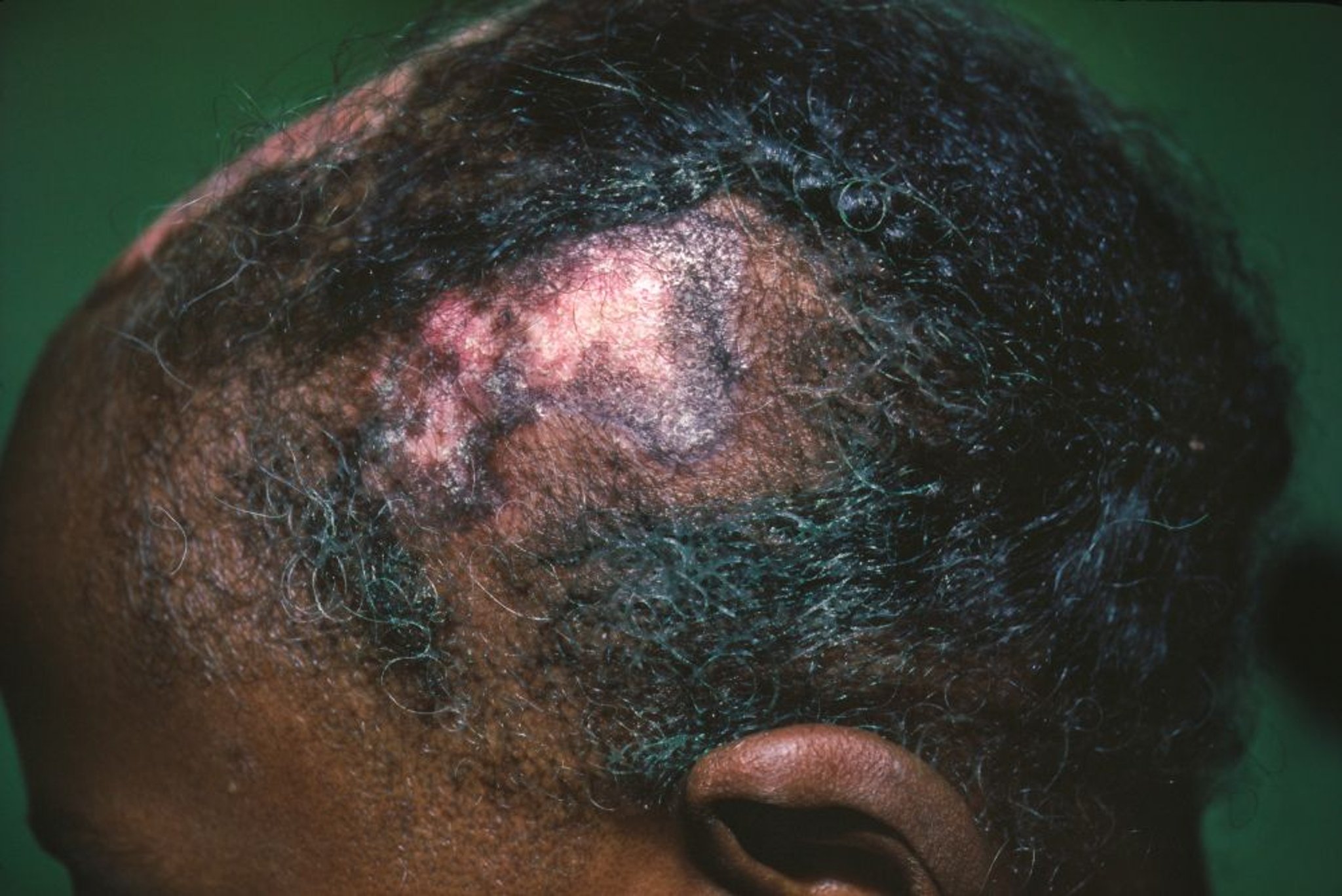 Lupus érythémateux discoïde de la face (1)