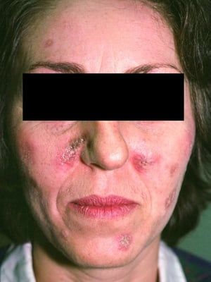Lúpus eritematoso discoide da face (1)