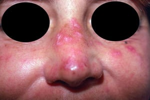 Lupus érythémateux discoïde de la face (2)
