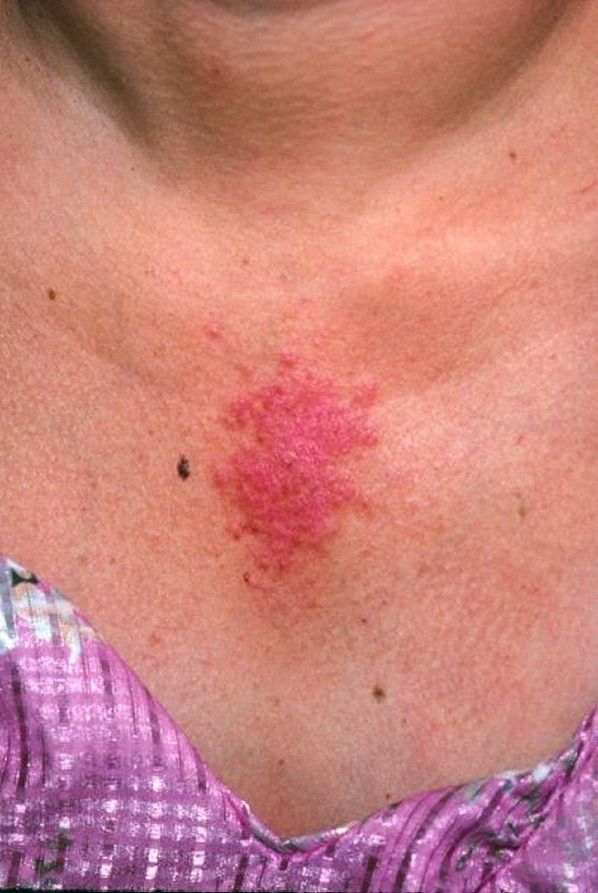 Subacute Cutaneous Lupus Erythematosus