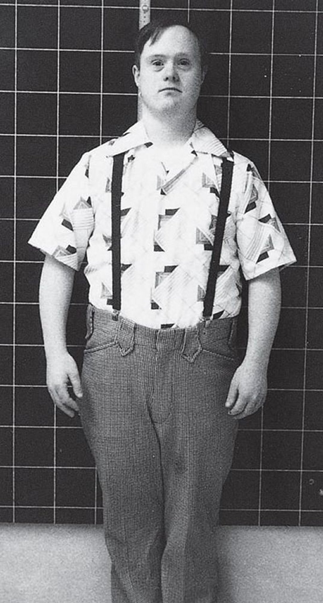 唐氏综合征