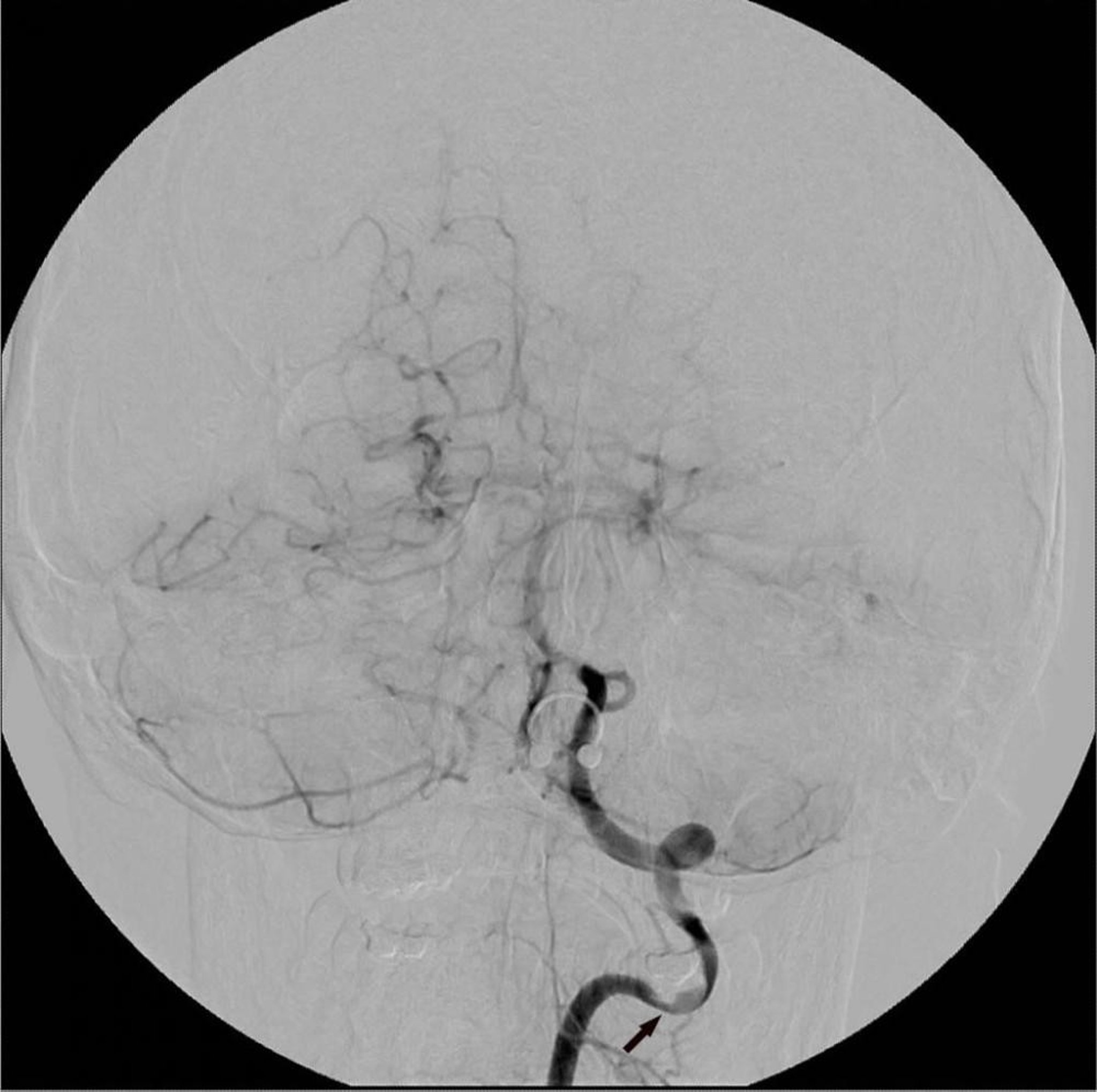 Digital Subtraction Angiography
